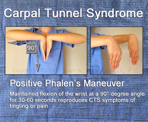 median nerve compression test cts|positive phalen's test.